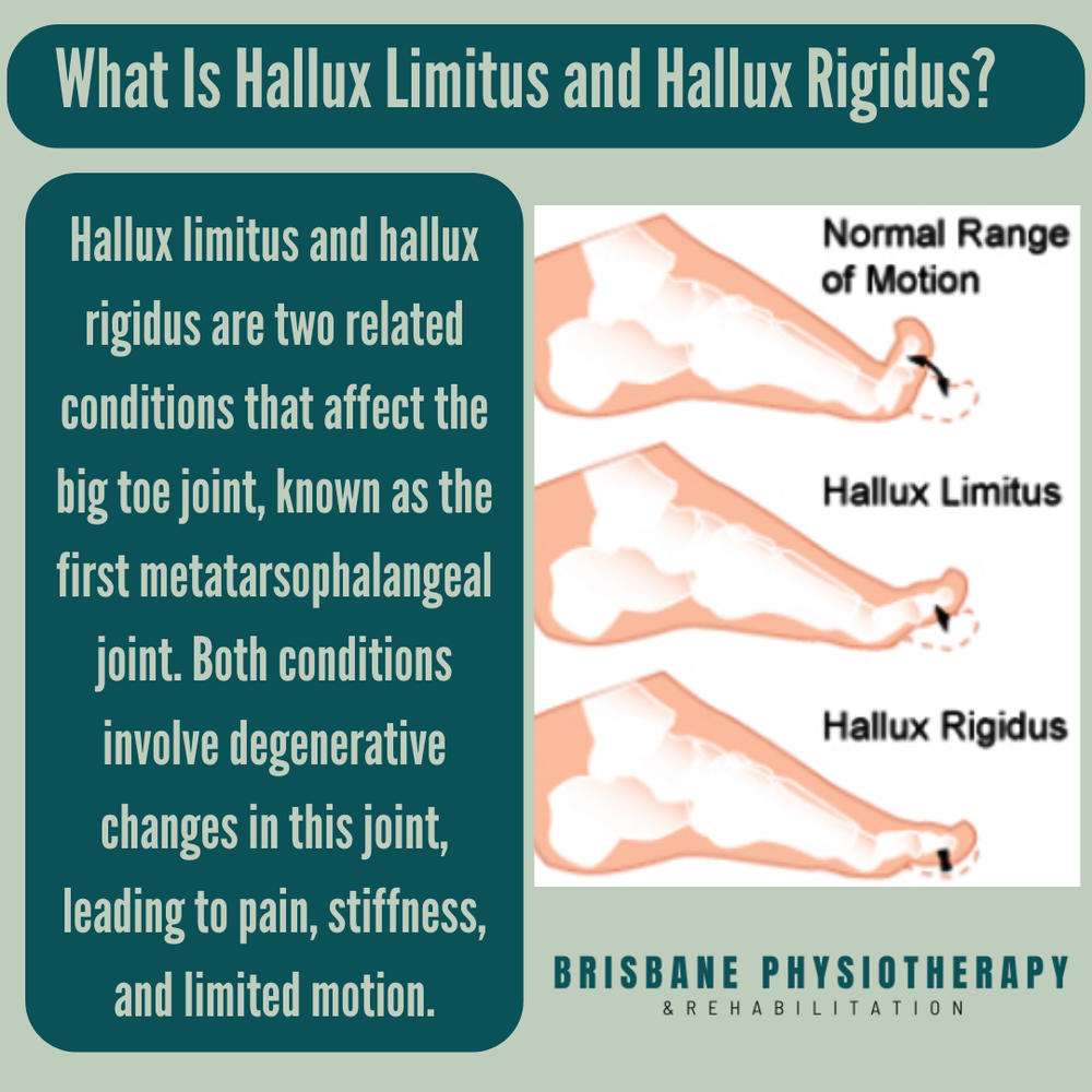 Hallux Limitus & Hallux Rigidus - Causes, Symptoms, Diagnosis ...