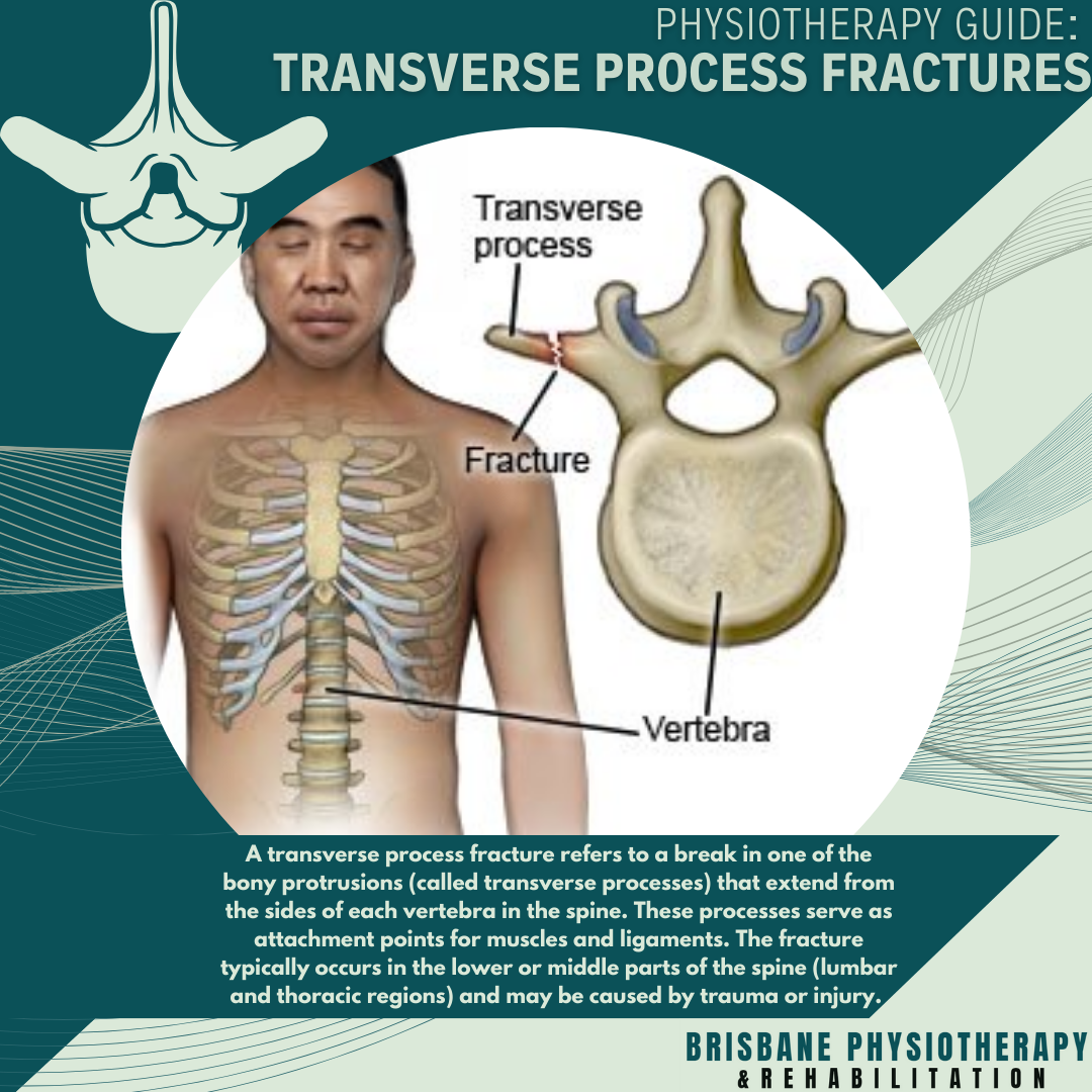 Physiotherapy Guide: Transverse Process Fractures - Brisbane ...