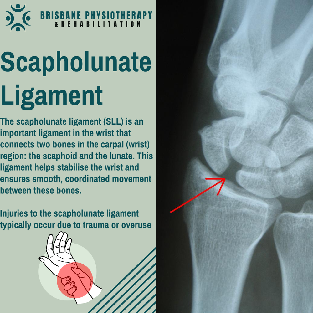 Scapholunate Ligament Injuries: Physiotherapy Guide - Brisbane ...