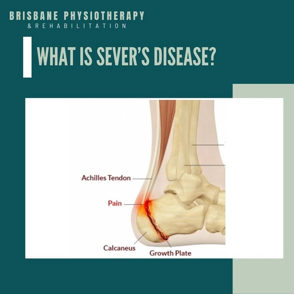 Severs Disease