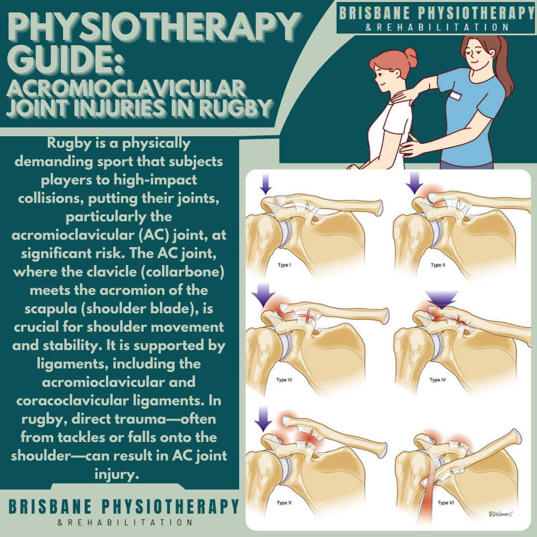 Acromioclavicular Joint Injuries in Rugby - Brisbane Physiotherapy ...