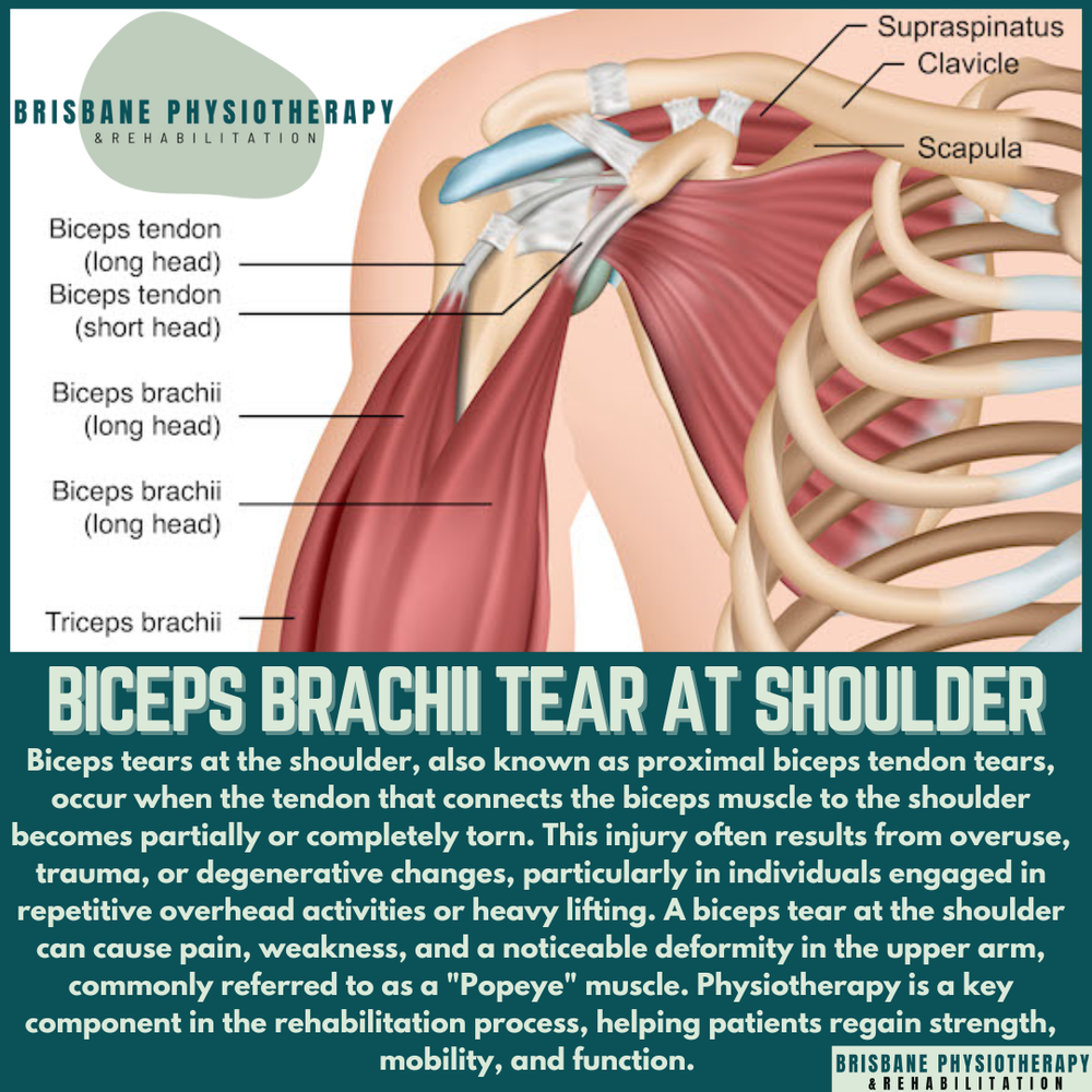 Bicep Tear at the Shoulder
