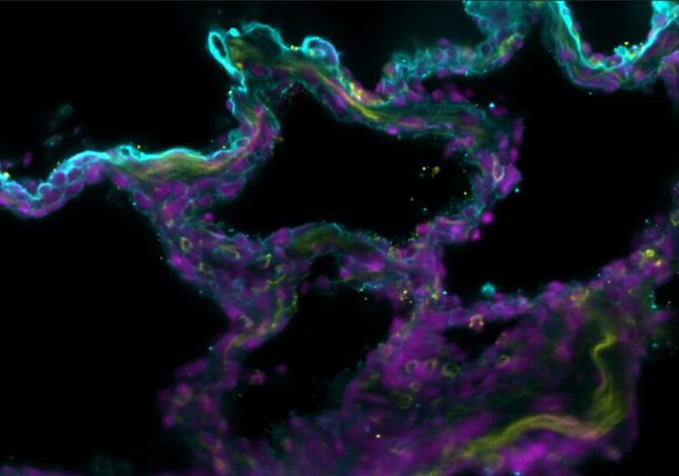 Lung IPF in 3D tissue imaging