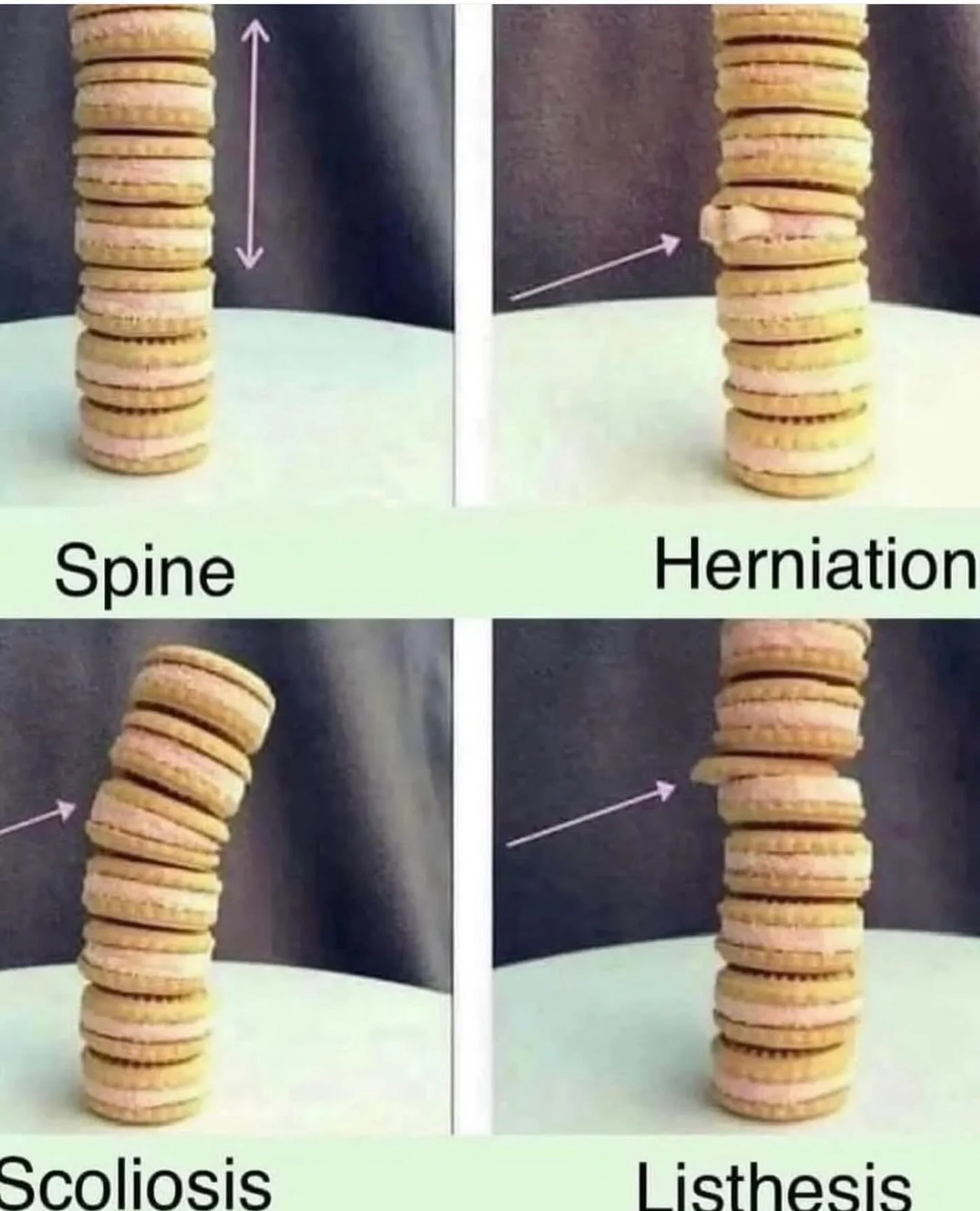 Happy Fat Tuesday! Let's break down some spinal terms with a sweet twist! 
- Herniation: when a disc pushes through its outer wall
- Scoliosis: abnormal curvature of the spine
- Listhesis: when one vertebrae slips forward or backward on another. 
Enj