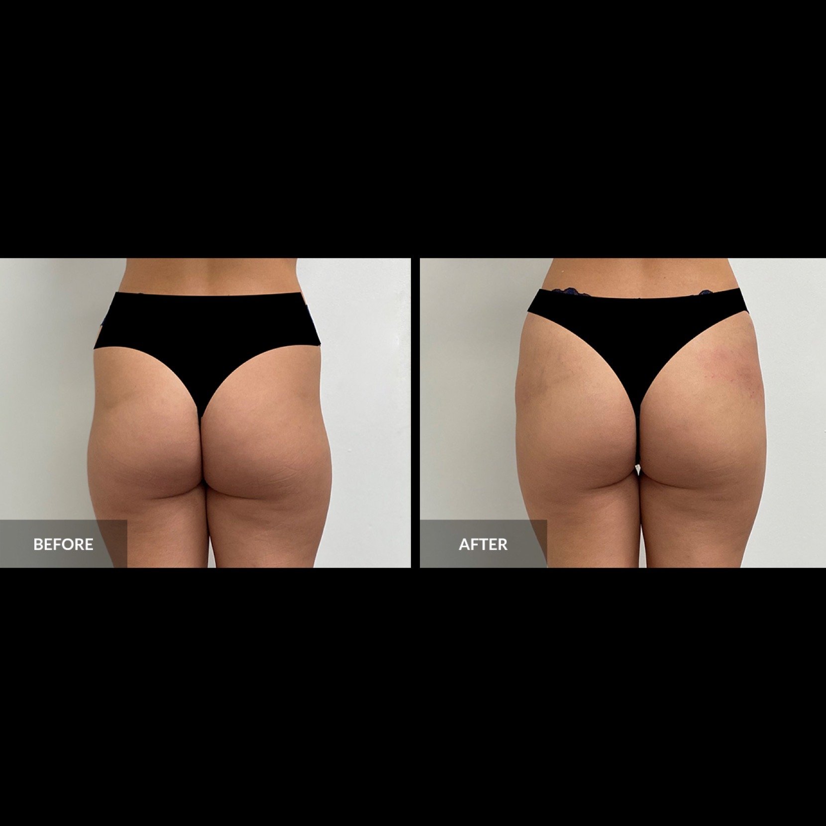 Sculptra Hip Dip Correction — PLUMP MEDICAL SPA