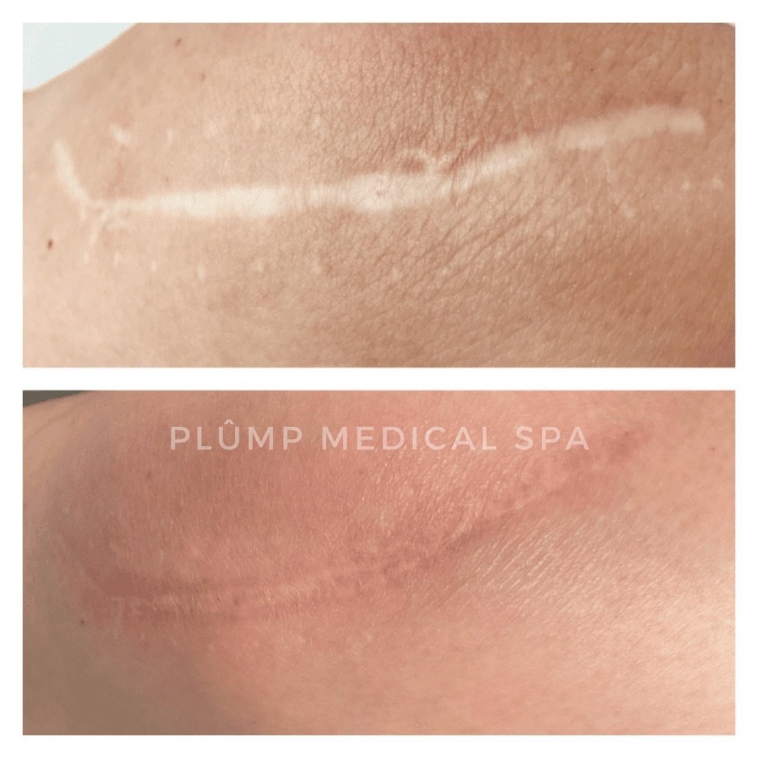⚡️⚡️KELOID AND SURGICAL SCARS:

Our advanced Erbium Nd:YAG and CO2 laser therapy effectively targets scar tissue while preserving surrounding skin. It works by:

Erbium Nd:YAG Laser:

Precisely removes scar tissue.

Promotes collagen remodeling.

CO2