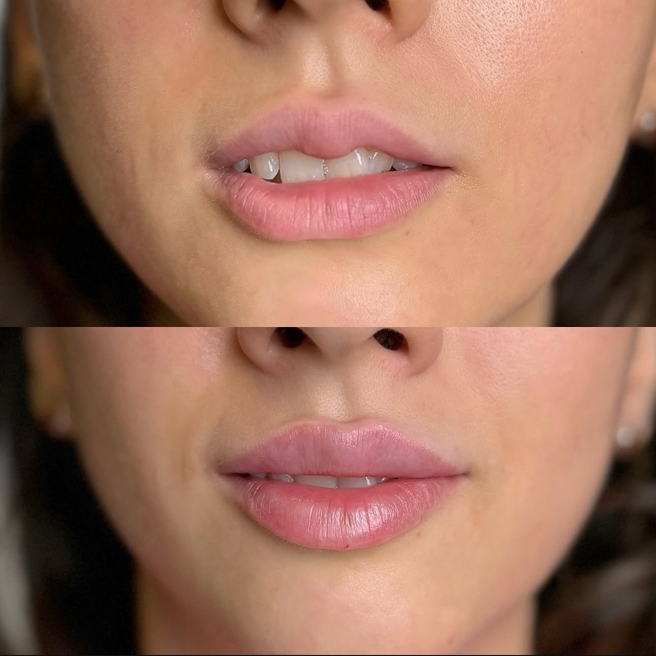 Balanced proportion, softened edges, and hydrated volume&mdash;no overfilling, just precision. 💉 👄