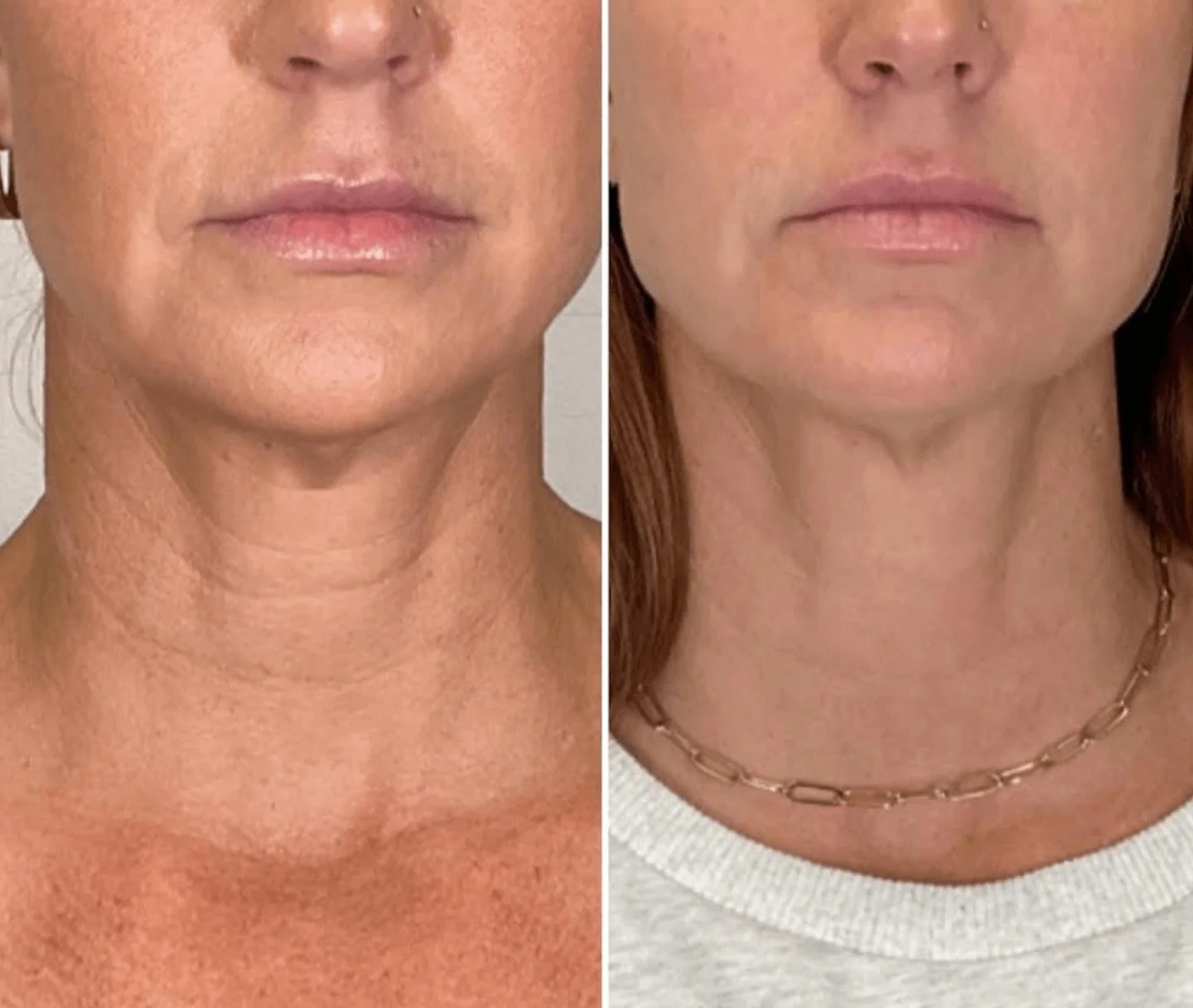 Neck? Snatched.✨
Radiesse to restore structure + collagen 💉
Botox to relax horizontal lines 💆&zwj;♀️
The combo = smoother, firmer, younger-looking skin&mdash;without surgery.
Swipe for proof 📸
#NeckRejuvenation #RadiesseNeck #BotoxNeckLift #PlumpM