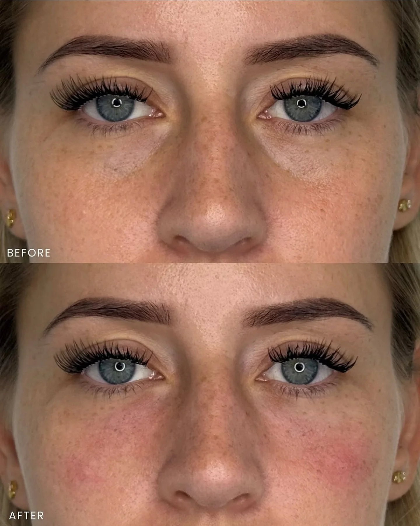 Are your eyes making you look tiered? We specialize in the treatment of this common problem. Schedule your free consultation by clicking the link in our bio. 💉👁️