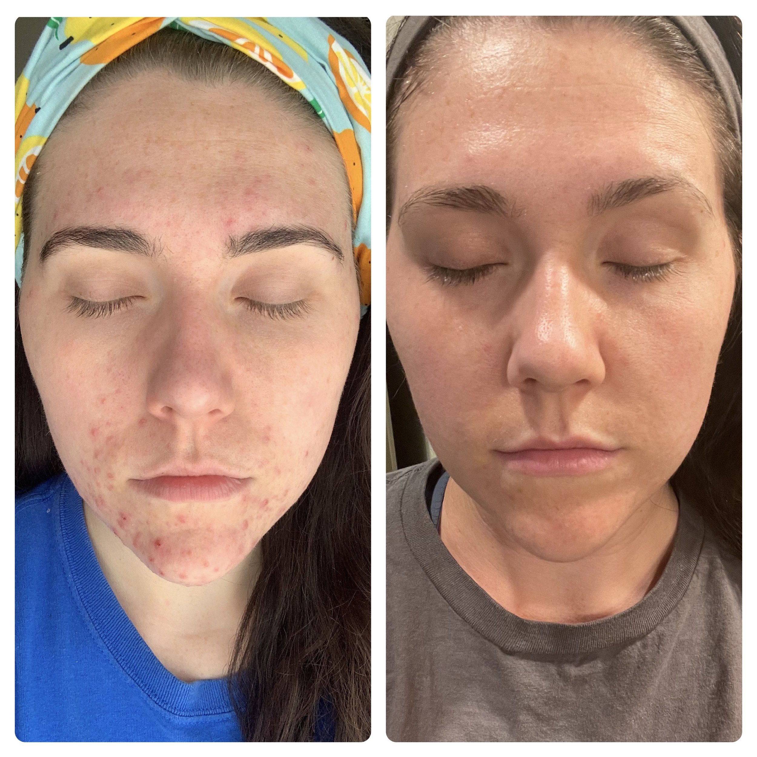 My Cystic Acne Story And How I Healed