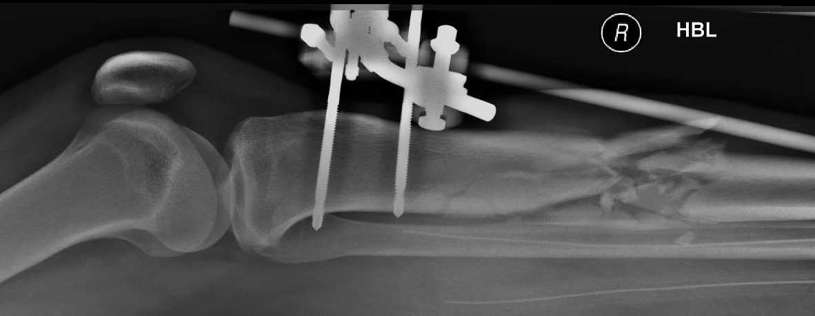LATERAL Tib GSW.jpg