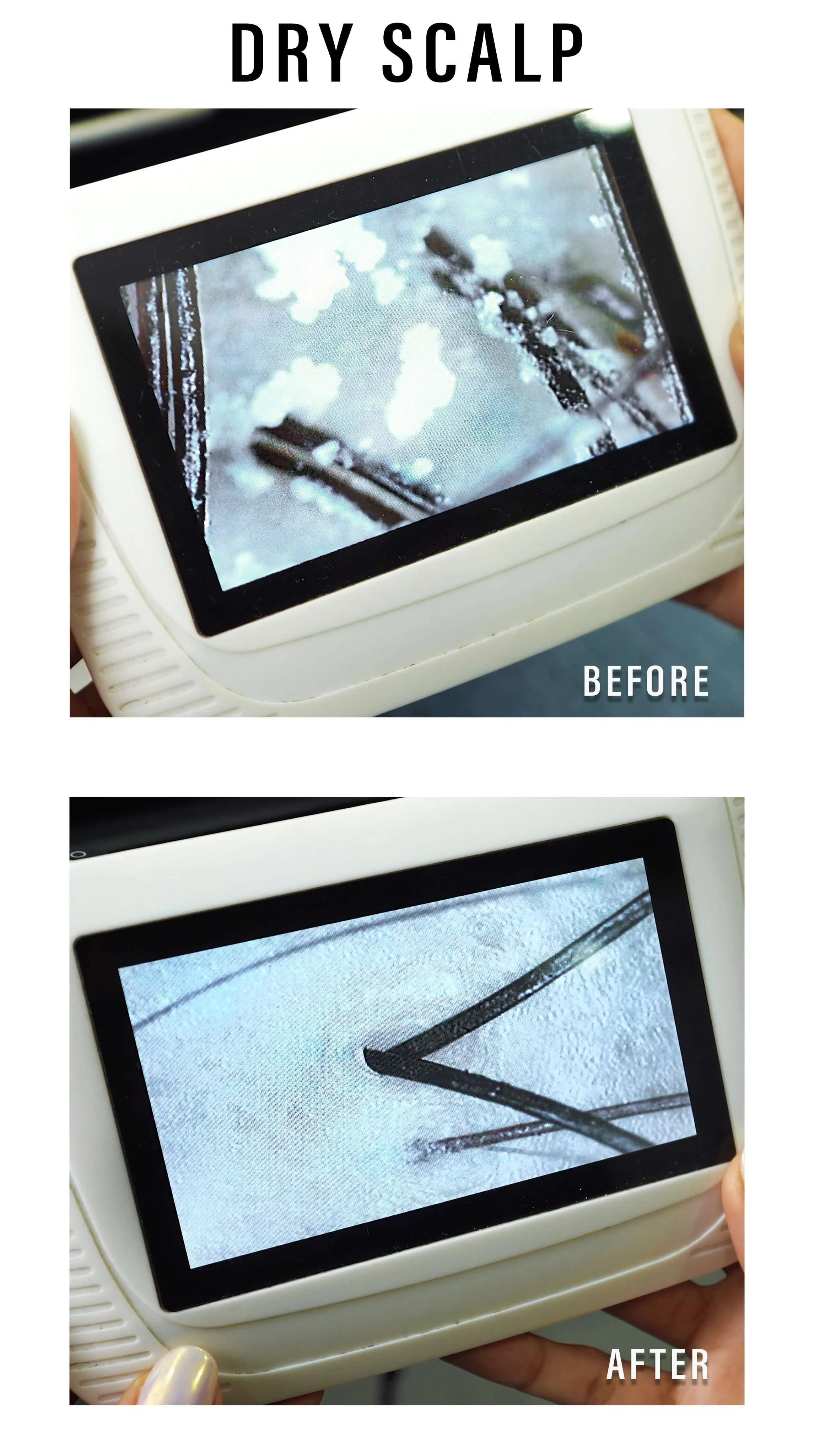 Scalp Analysis for Hair And Scalp Treatment