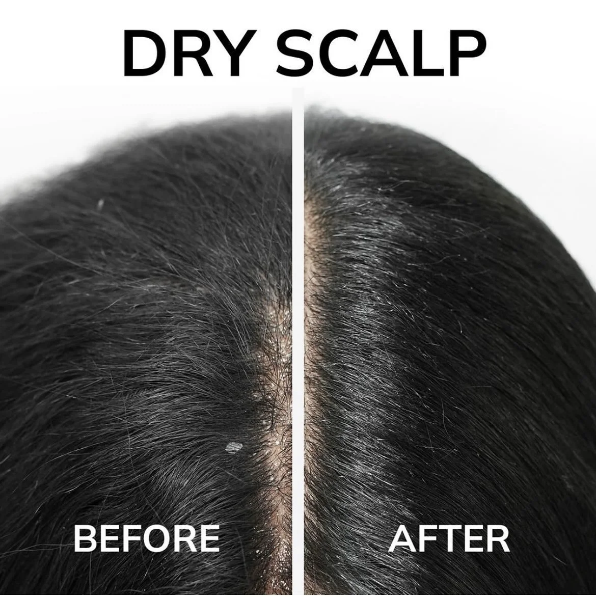 Dry Scalp Before And After for Hair And Scalp Treatment