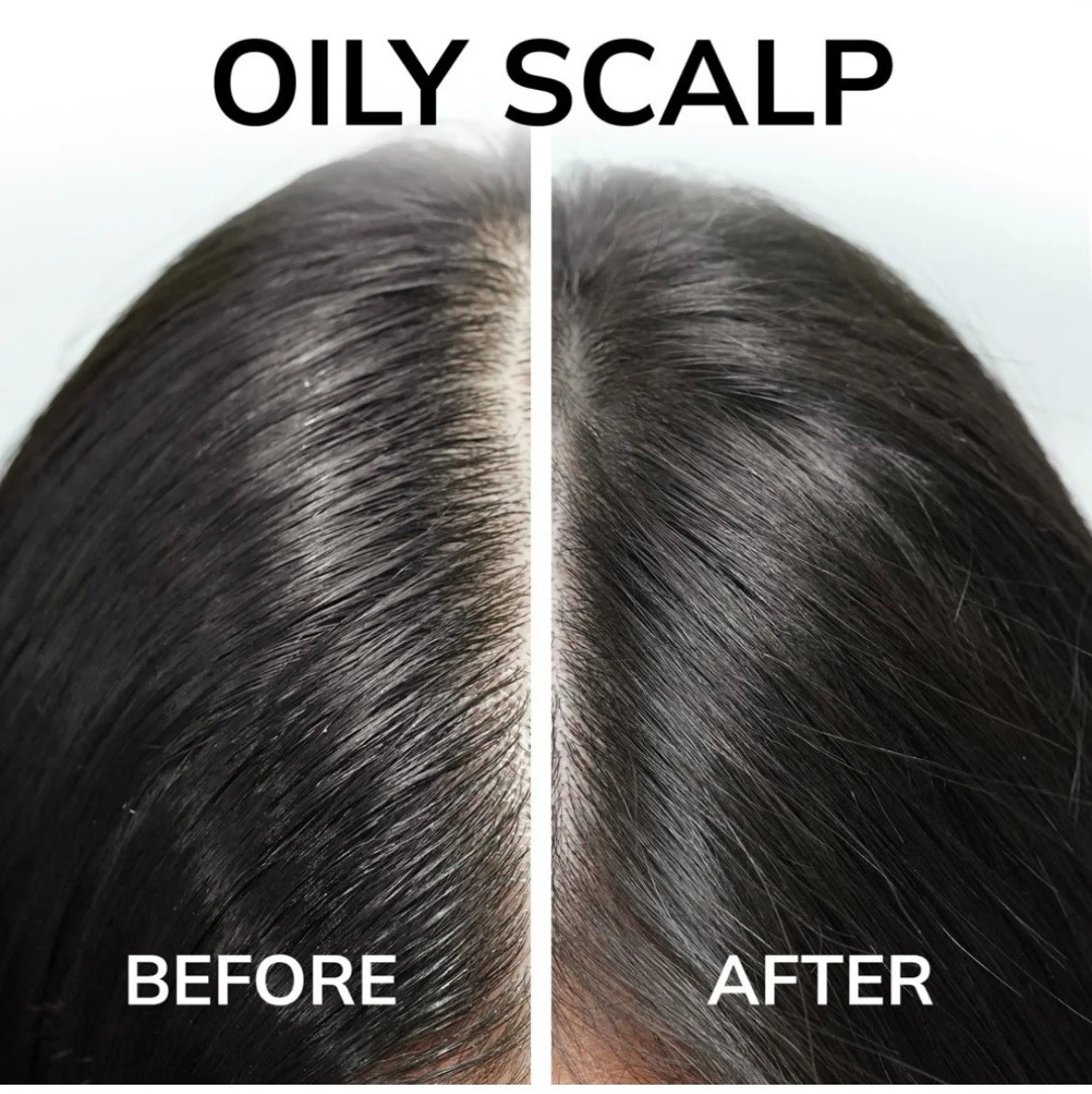 Oily Scalp Before And After : Hair Treatment