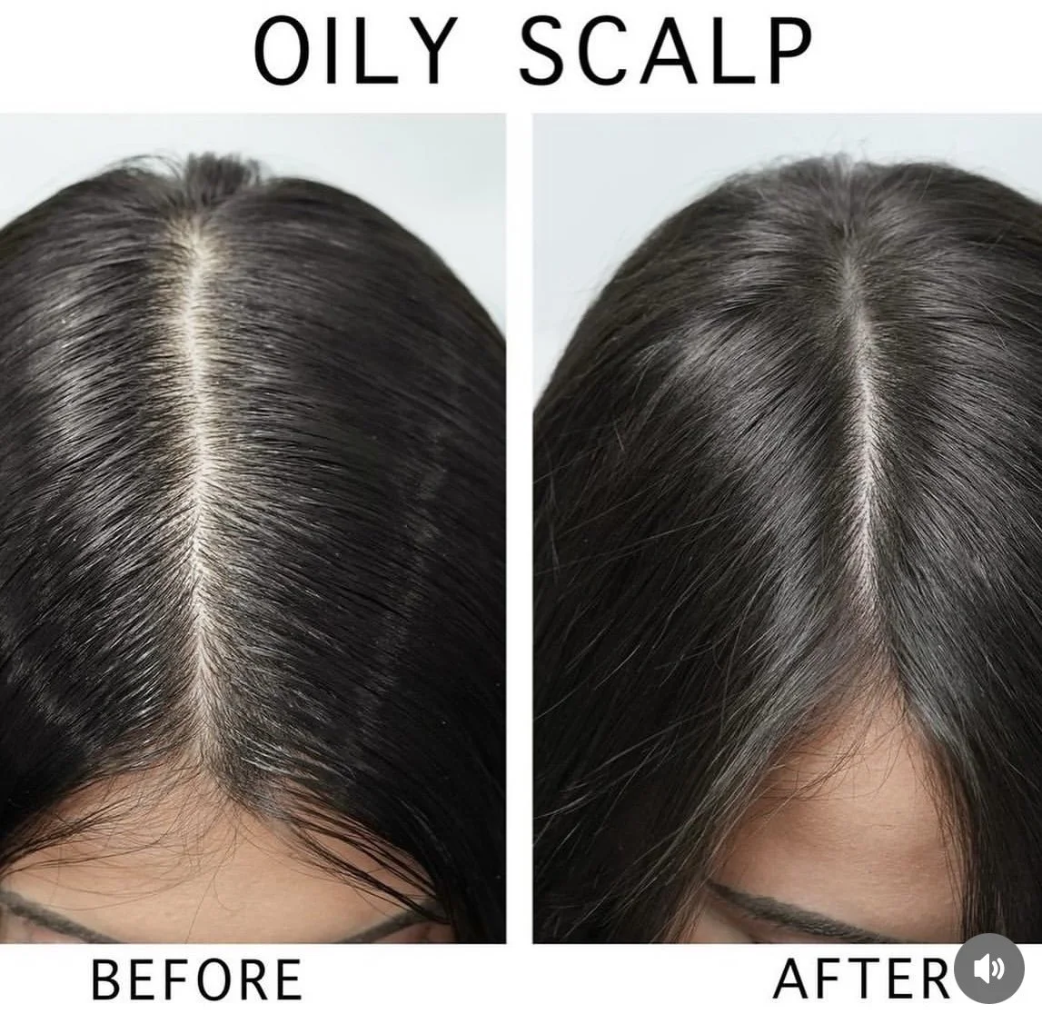Before and After Photos: Oily Scalp
