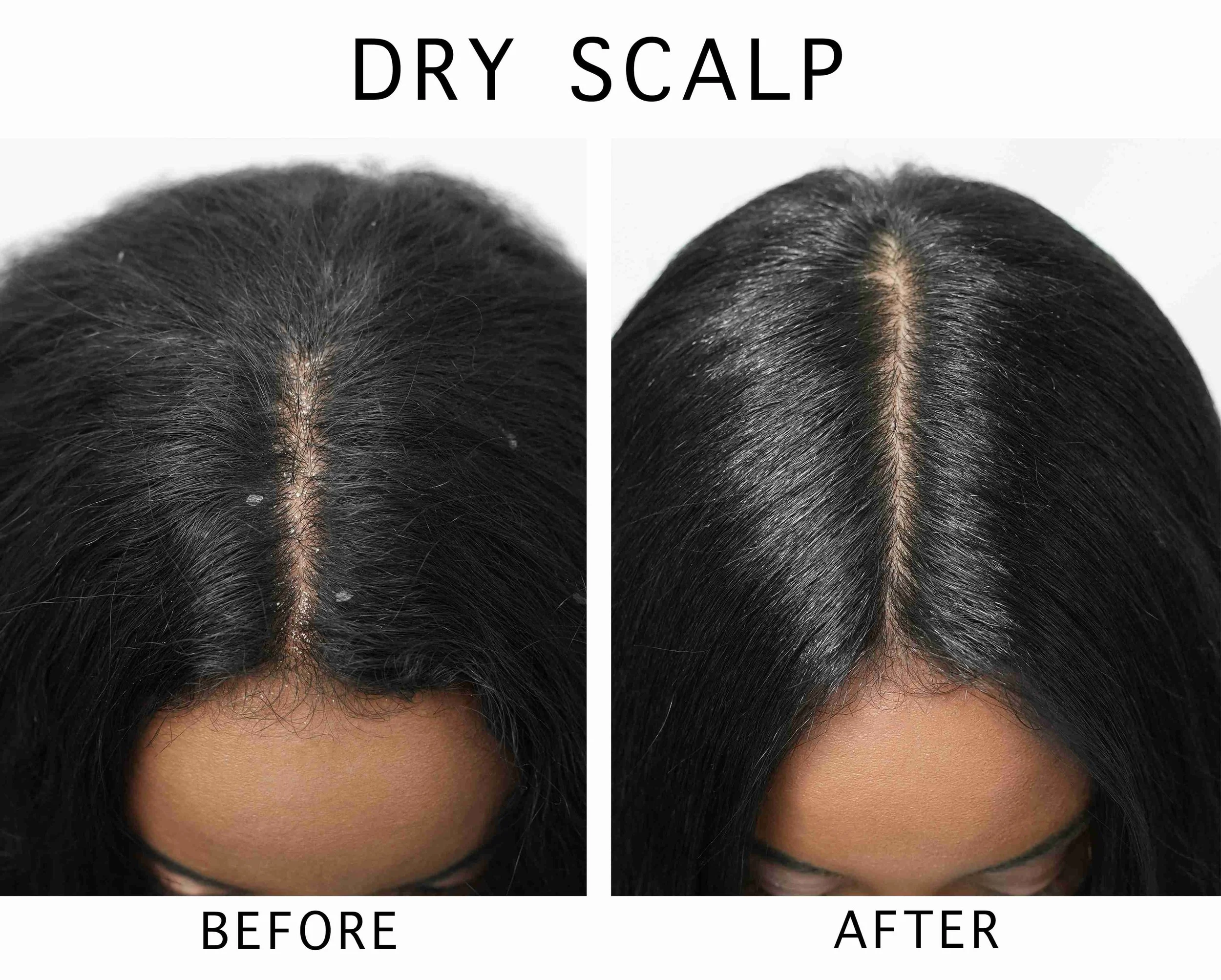 Before and After Photos: Dry Scalp