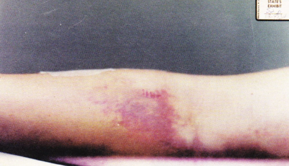 bruises 2.png