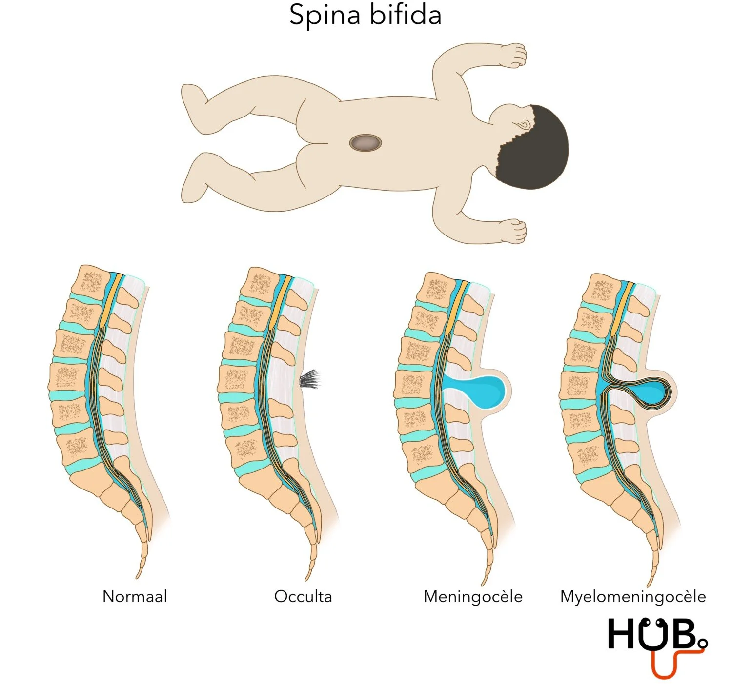Spina Bifida Geneeskundehub