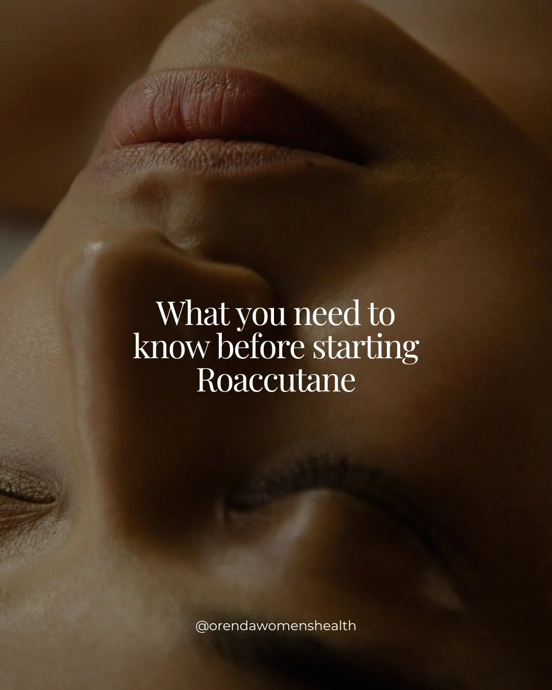 Thinking of going on Roaccutane?

Okay, so if you have acne we pretty much know that if you&rsquo;re going to see a specialist you&rsquo;re going to be offered one of three options (most of the time)

1. Something for your hormones - The pill (or spi