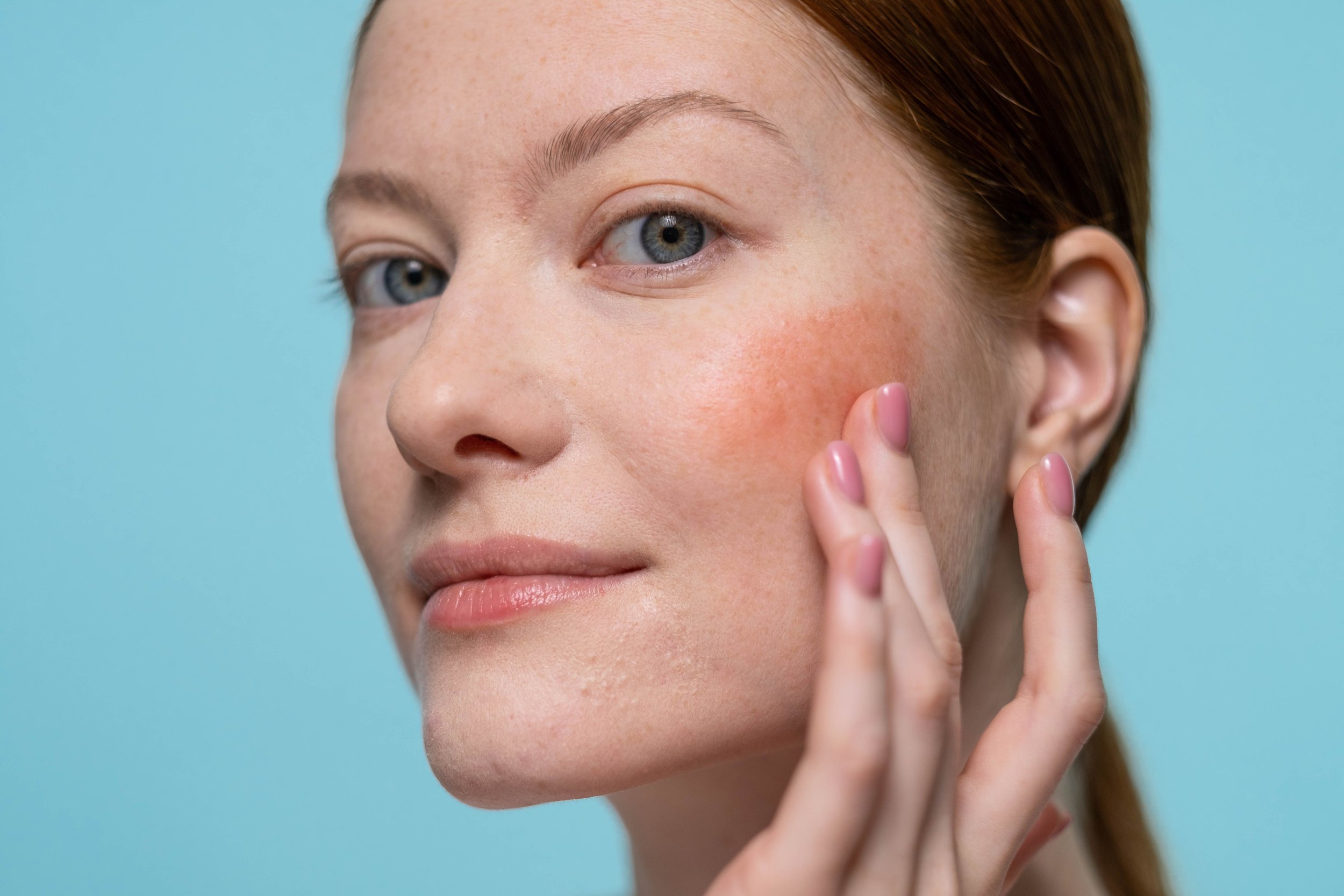Rosacea &amp; Skin Needling