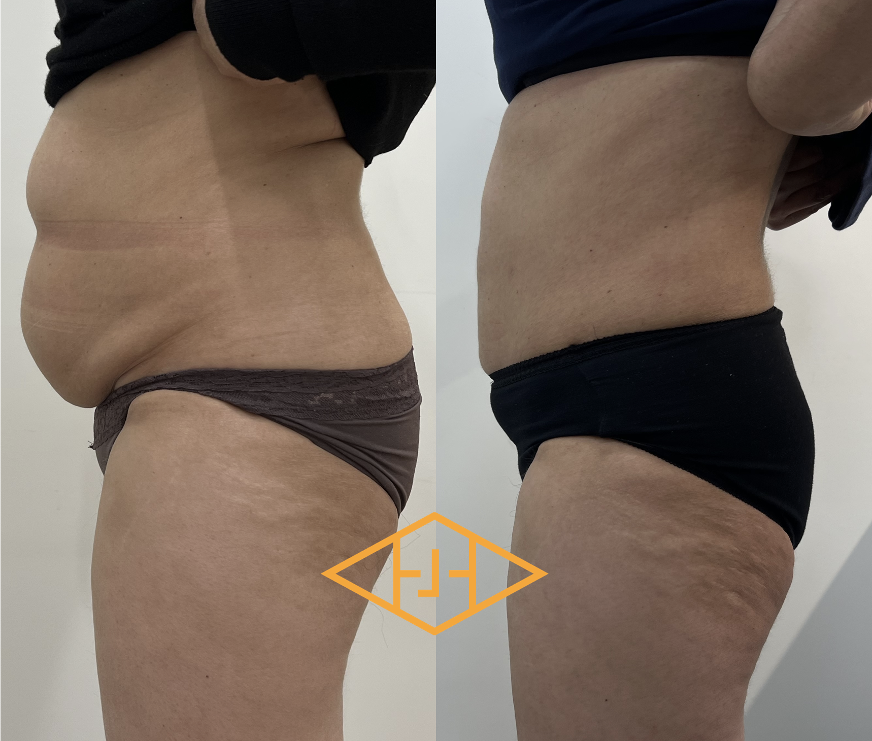 Post-op 6 mois liposuccion du ventre de flancs
