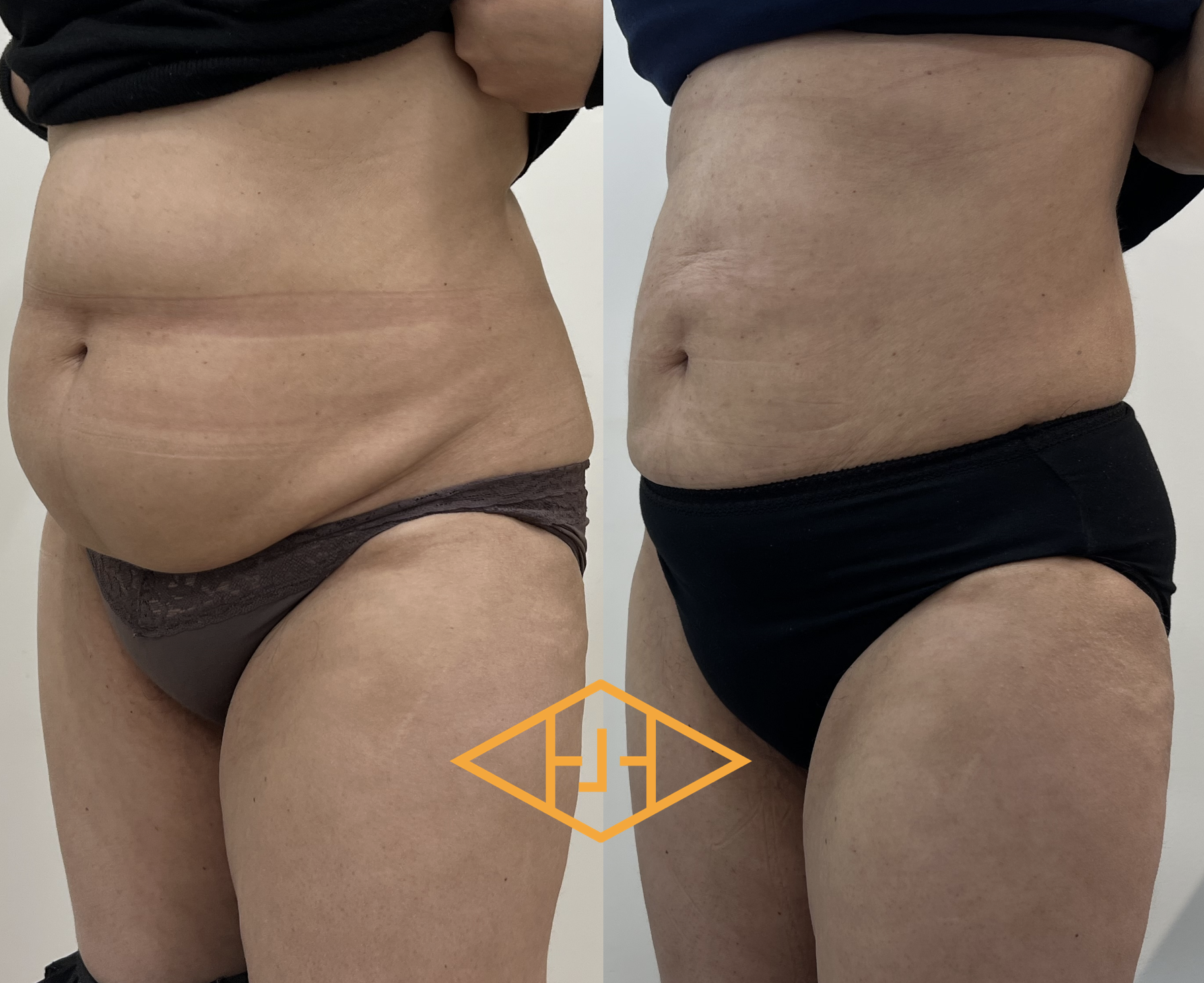 Post-op 6 mois liposuccion du ventre de flancs