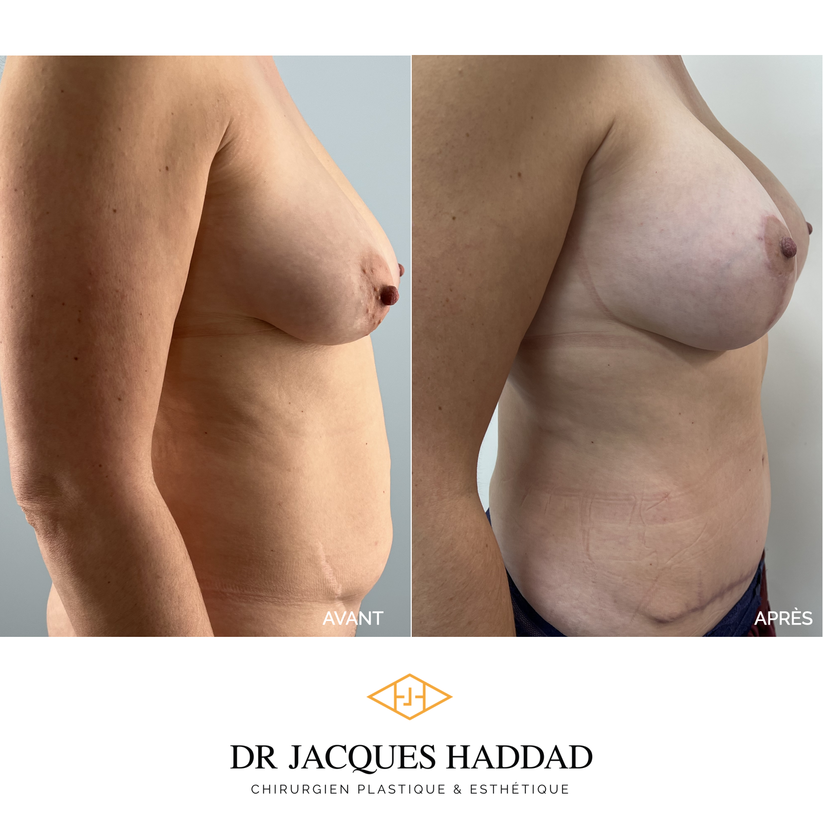 Breast augmentation - Dr Jacques Haddad