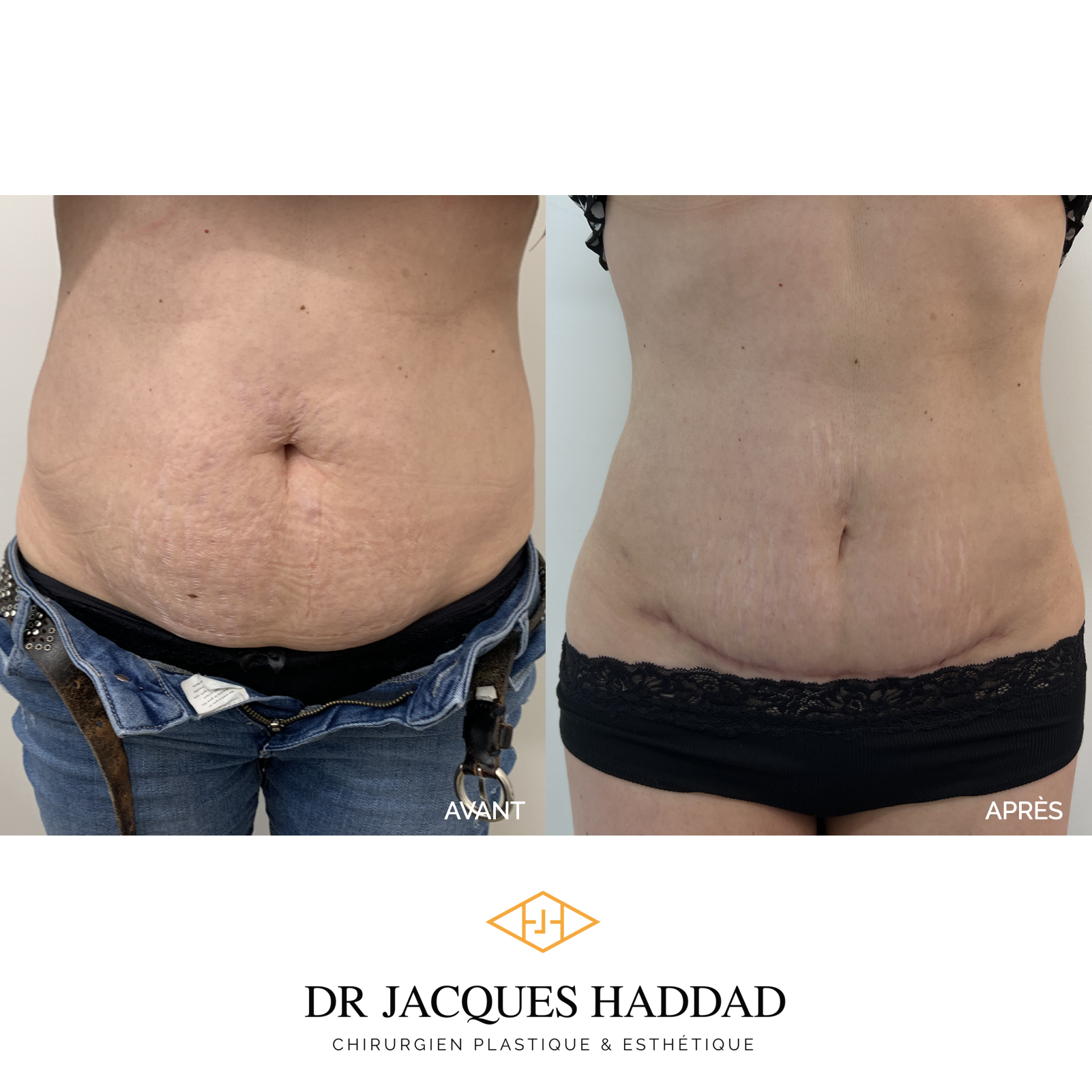 Abdominoplastie - chirurgie esthétique du ventre, liposuccion — Dr ...