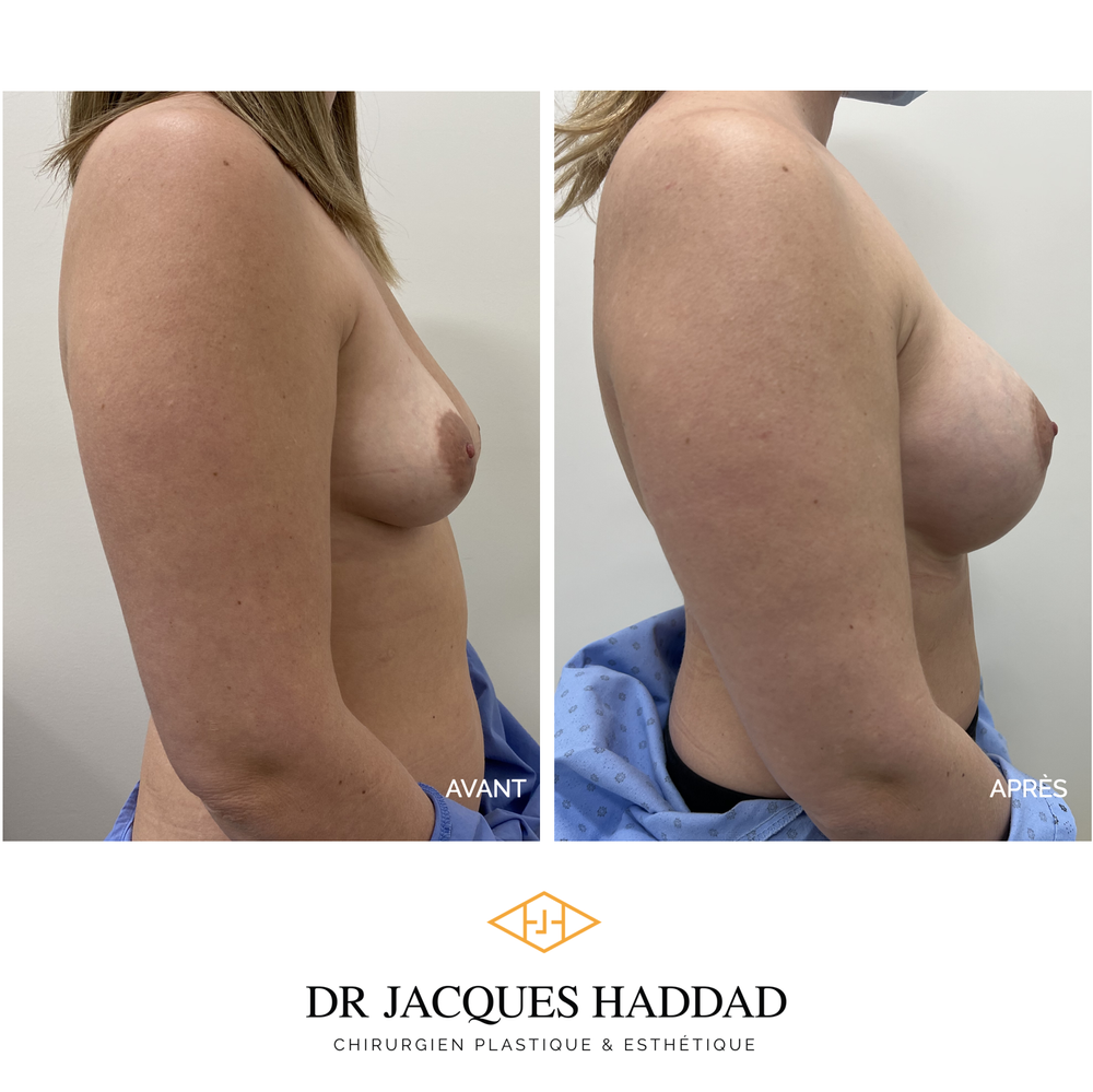 Augmentation mammaire — Dr Jacques Haddad