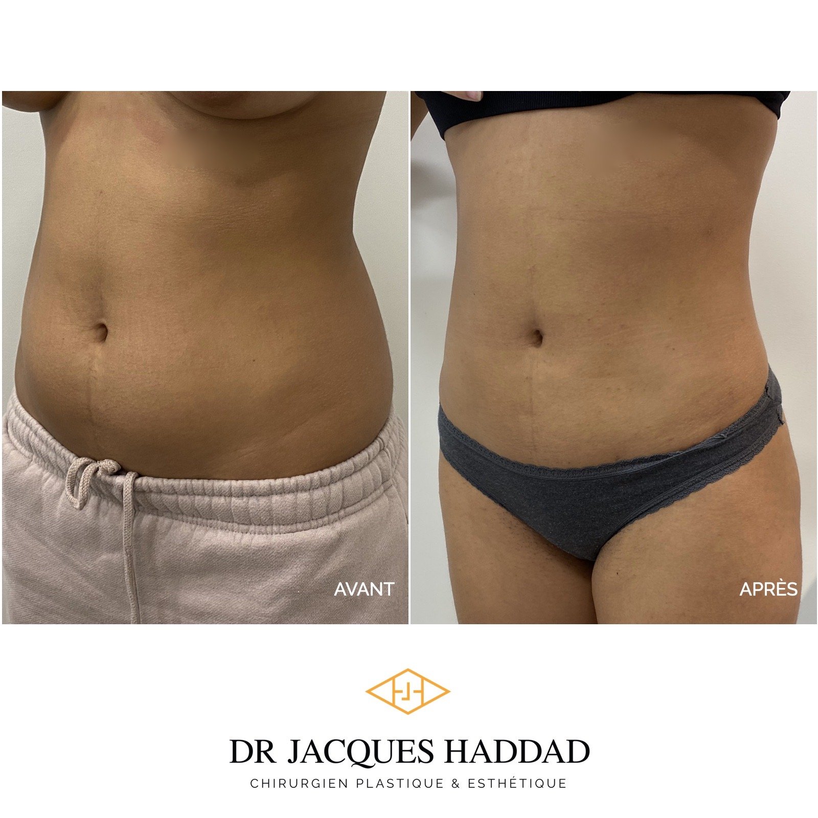 Post-op 6 months liposuction belly and flanks