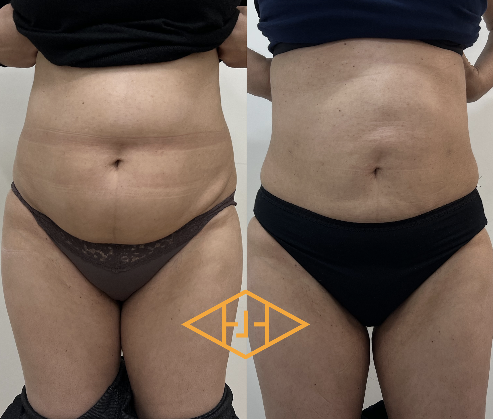 Post-op 6 mois liposuccion du ventre de flancs