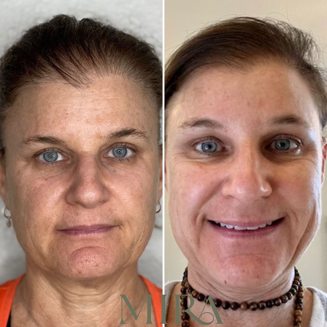 Incredible PRX T33 Peel results for this Mira Med Spa patient whose main skin concerns were pigmentation and dull looking skin 

PRX delivers noticeable results almost instantly 👀 and can be done anytime throughout the year including summertime (a h