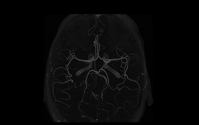 Sex differences in stroke mechanisms