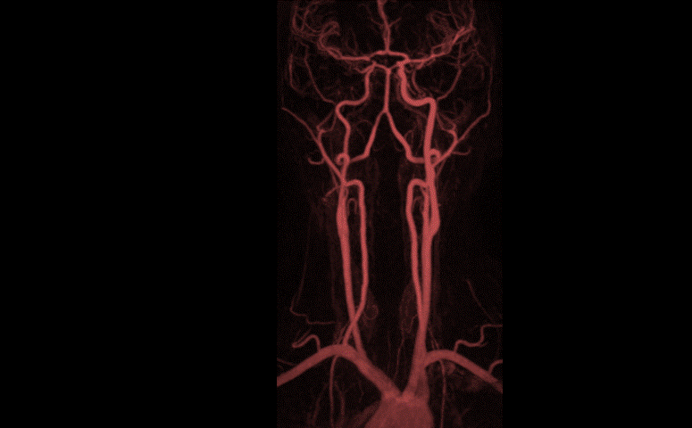 Vessel wall imaging of cerebrovascular disease