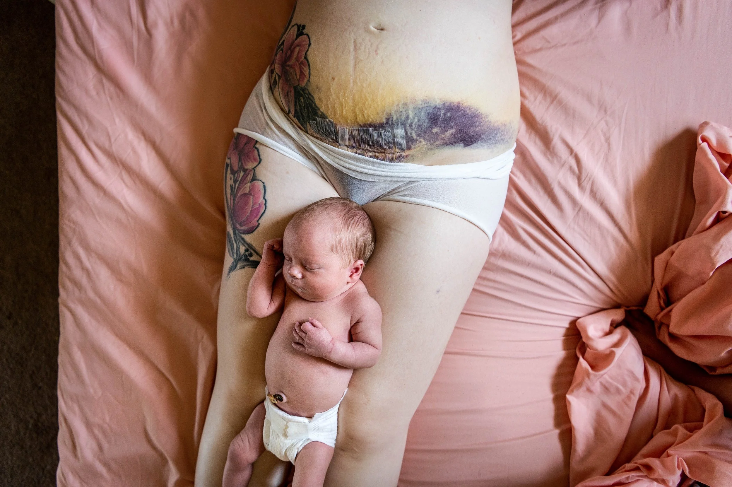 Mother lays on her back in mesh underwear with Cesarean scar and bruising exposed and newborn baby on her legs