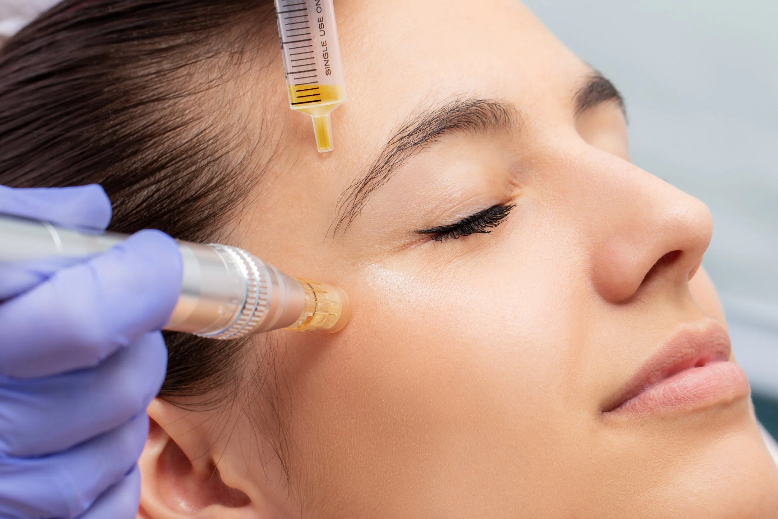 Close-up of a woman receiving a cosmetic injection near her cheek, with a medical professional wearing purple gloves administering the treatment.