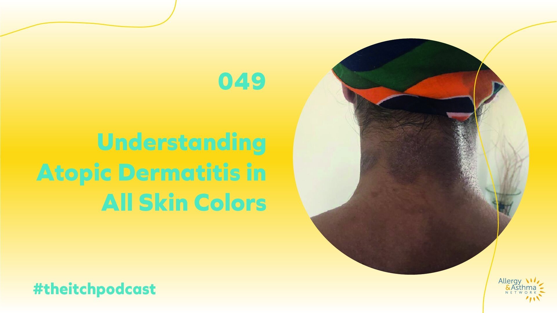 Ep+49+Understanding+Atopic+Dermatitis+in+All+Skin+Colors-12.jpg