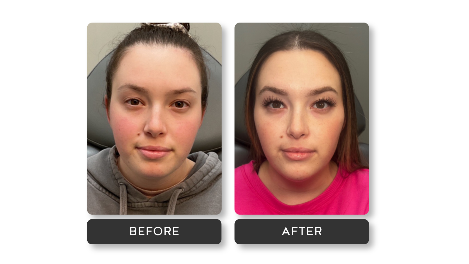 Liquid Facelift results on model from A Younger You Aesthetics Med Spa