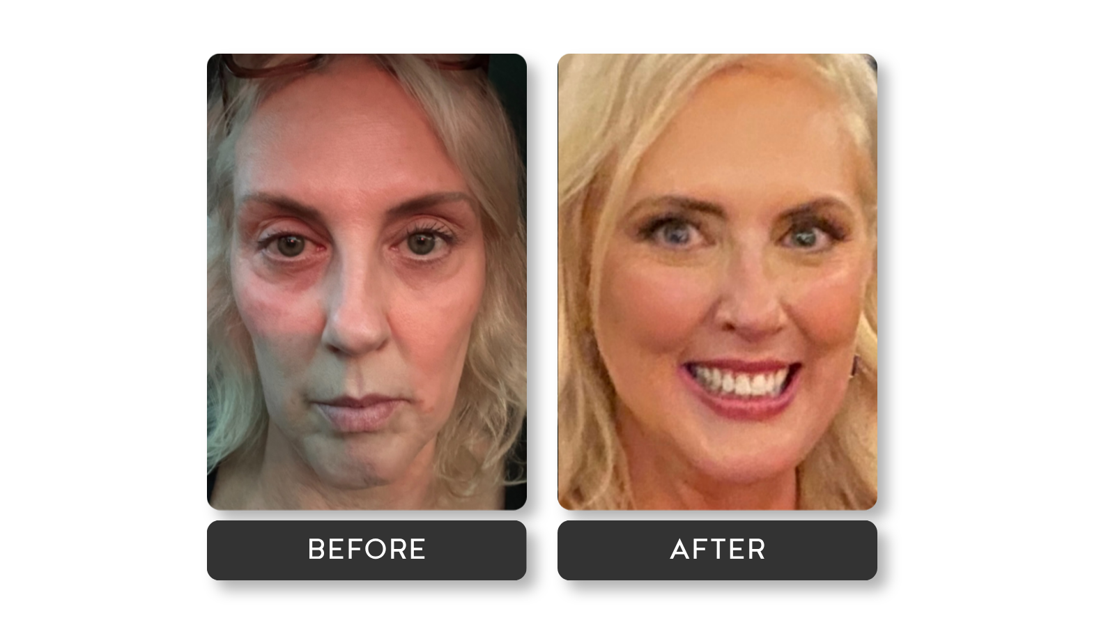 Signature Refresh results on model from A Younger You Aesthetics Med Spa