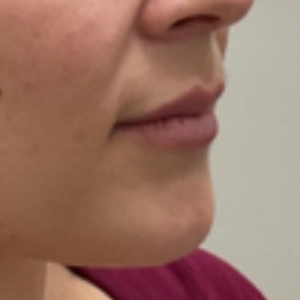 Lip-filler-1.jpg