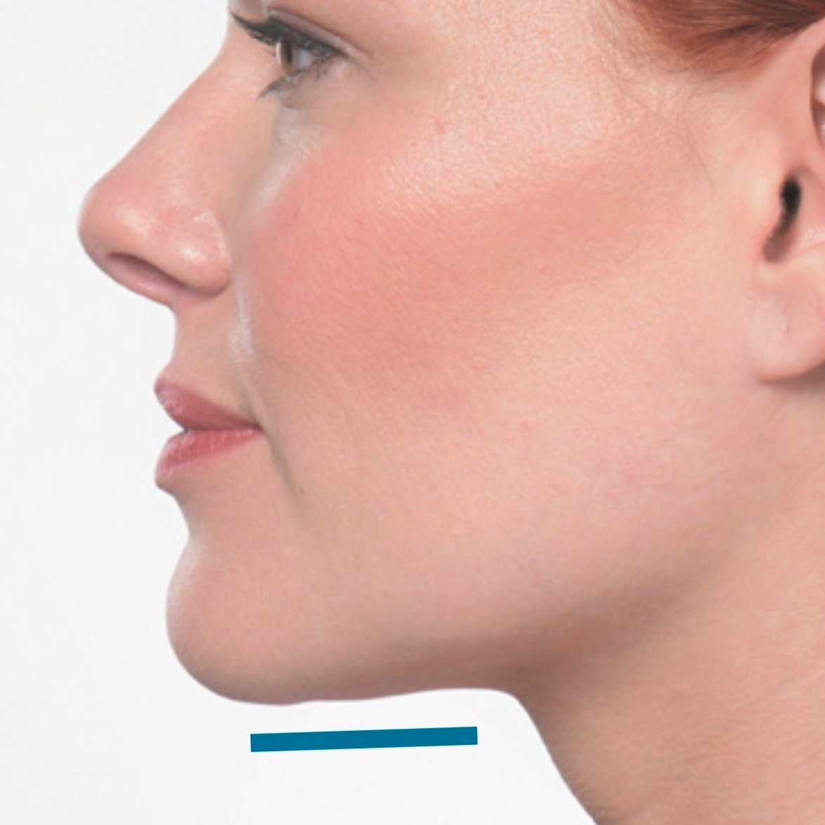 Kybella+after.jpg