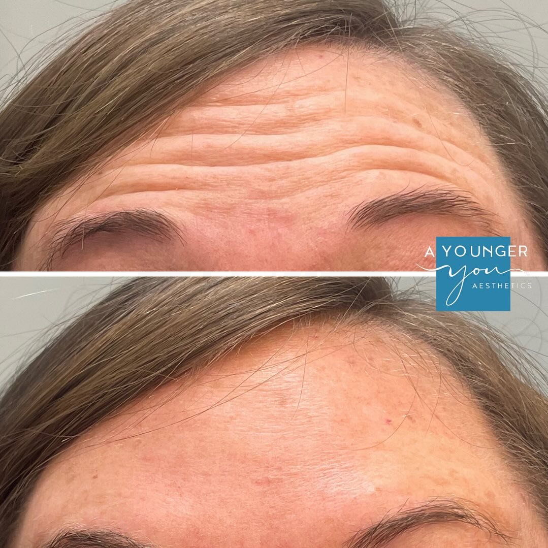 ✨ Botox and Dysport can effectively address forehead lines, leaving you with a refreshed and rejuvenated look.  Experience the confidence that comes with feeling your best!
💰 For a limited time, get $100 off your Botox treatment if you&rsquo;ve neve