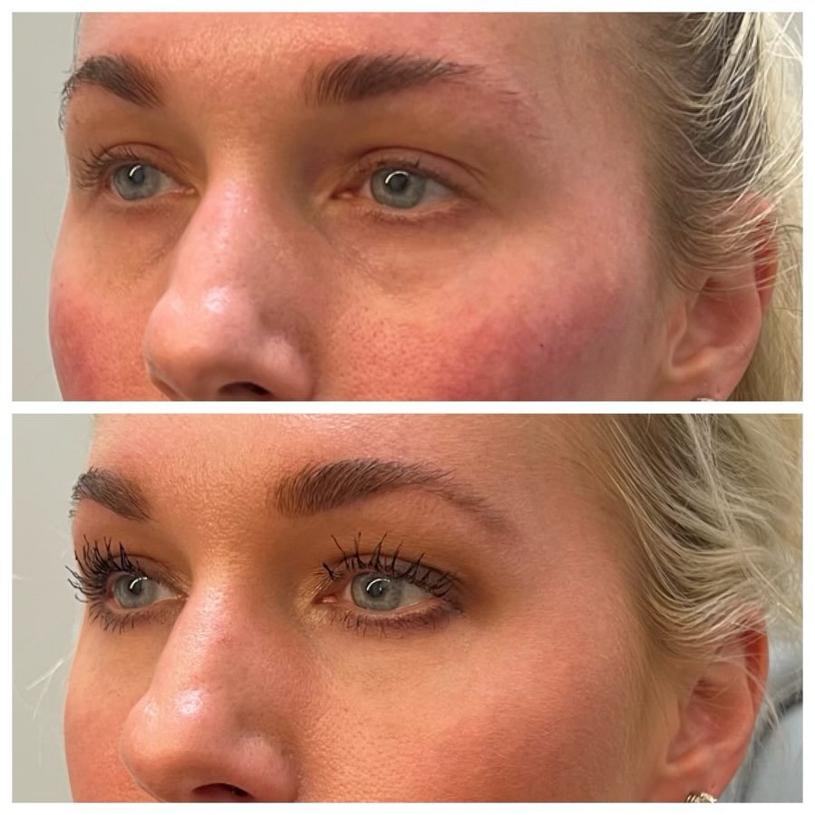 ✨Tired eyes? Say goodbye to under-eye hollows with Juv&eacute;derm Volbella! ✨
This amazing filler adds subtle volume to the tear trough area, creating a smoother, brighter under eye for a refreshed, youthful look.  See the difference for yourself!
-