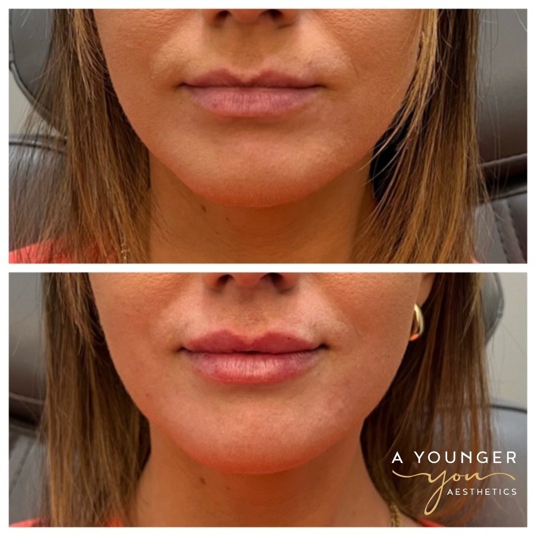 ❤️ We love lip transformations! During your consultation, your master injector will discuss with you the perfect filler for your desired outcome. 
💋 One filler we utilize often for patients looking for a more dramatic transformation is Juvederm Ultr