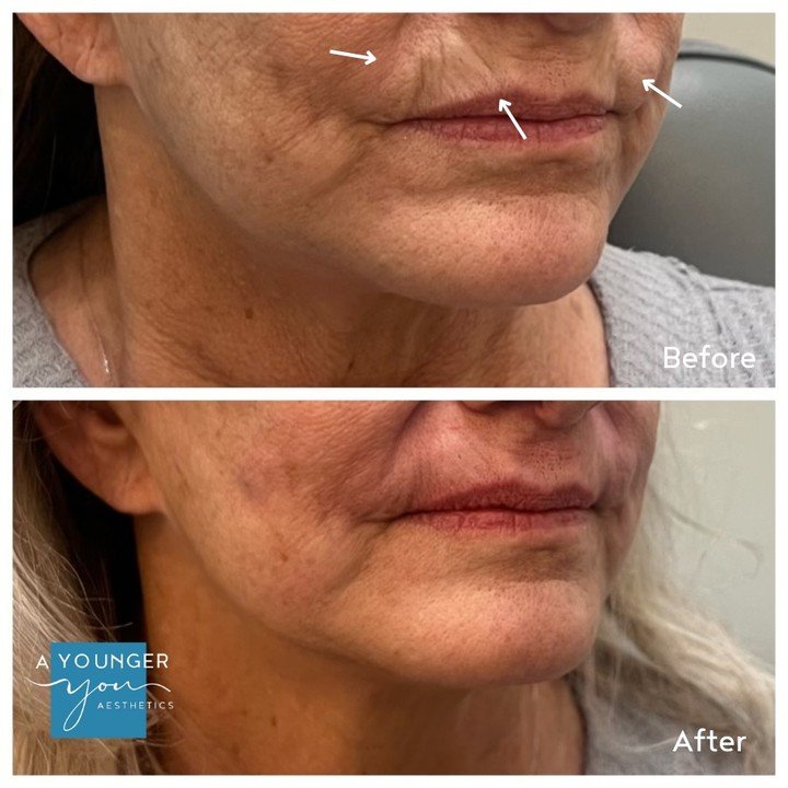 🤯 Look at these results!
✨ Kiss those lip lines goodbye
✨ Want a smoother, more youthful appearance around your mouth? Perioral lines (vertical lines around the lips) can be softened with dermal fillers! ✨
- Fillers add subtle volume, plumping the s