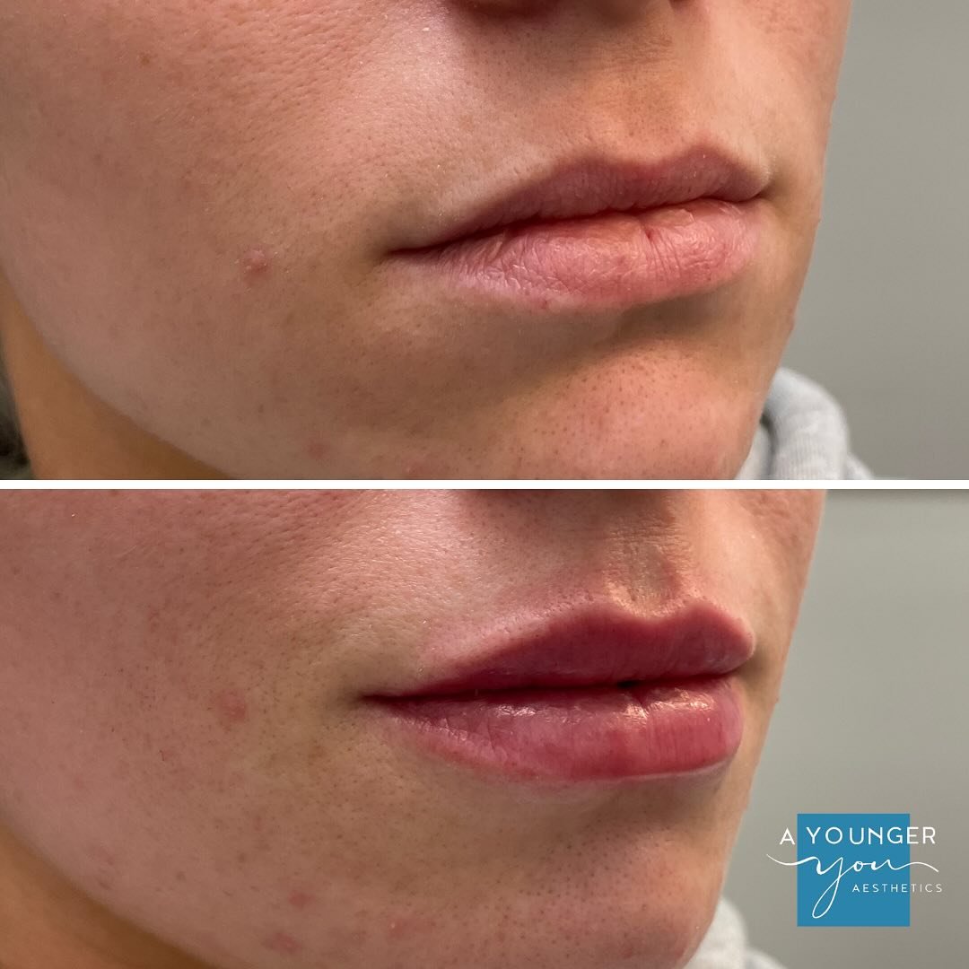 ❤️ Feeling like your best self, one kiss at a time!  Our client treated themselves to Juvederm Volbella and is loving the results. This gentle filler enhances your natural beauty, leaving you with fuller, smoother lips that boost your confidence from