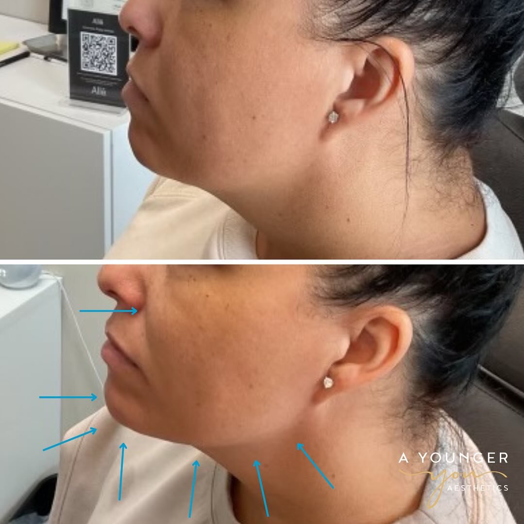 ✨ Chin up, cheeks out! ✨
Want a sharper jawline and a more defined profile? Facial fillers can add volume to your cheeks and chin, for a naturally sculpted look that enhances your features. ✨
-
-
#columbusmedspa #ohiomedspa #ayoungeryou #614beauty #p