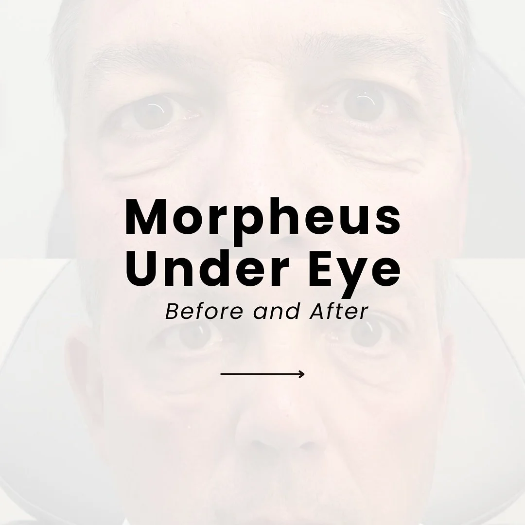 Tired eyes don&rsquo;t always need filler.

Morpheus8 under the eyes helps tighten and smooth delicate skin &mdash; improving fine lines and crepiness by stimulating collagen where you need it most.

It&rsquo;s a subtle, natural way to refresh your e