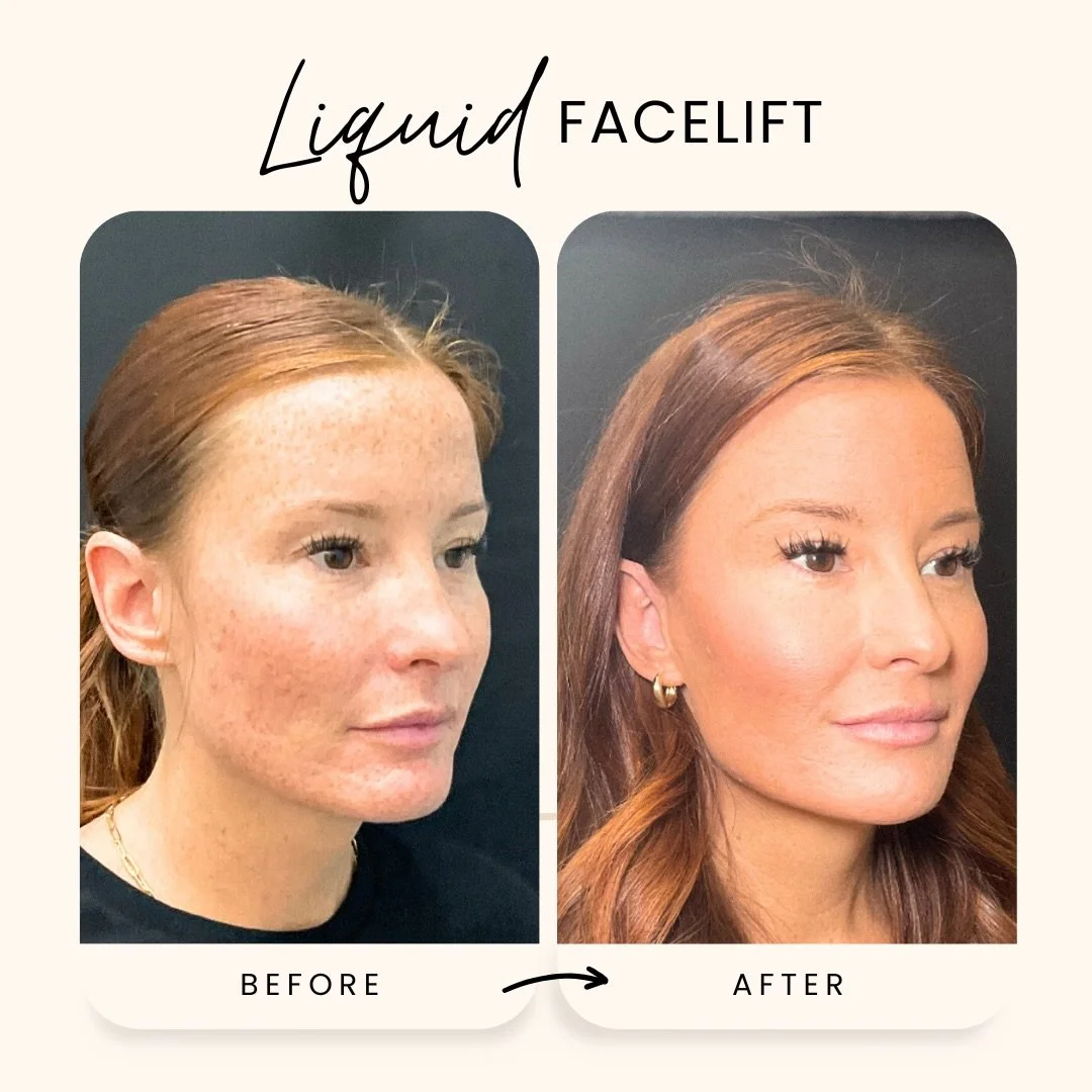 A beautiful full-face transformation ✨

Using our Liquid Facelift approach with Vollure, we smoothed the lower face, restored gentle volume, and enhanced overall balance &mdash; all without surgery.

This package addressed key areas like the cheeks, 