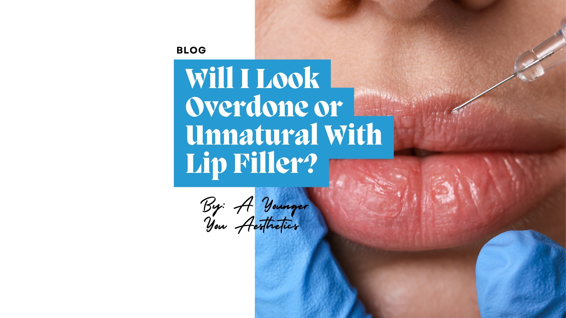 Will I Look Overdone or Unnatural With Lip Filler?